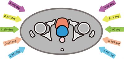 Dosimetric comparison of robust angles in carbon-ion radiation therapy for prostate cancer